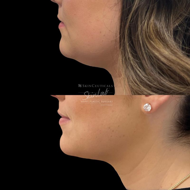 Kybella Treatment Marge Image