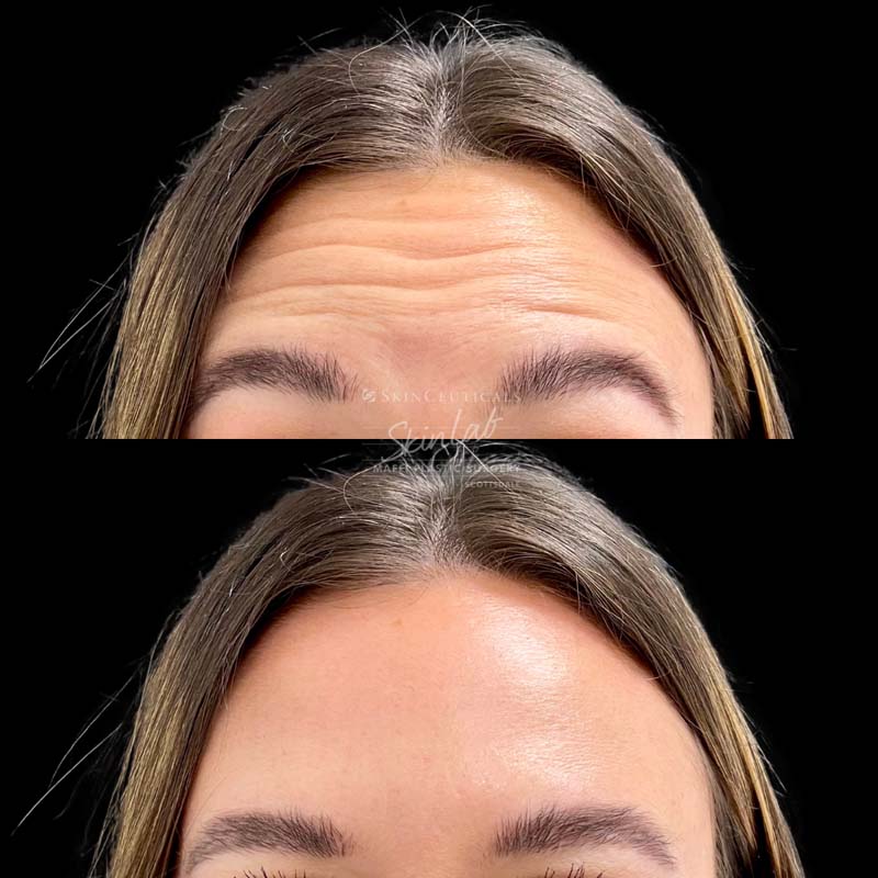 Botox Treatment Marge Image