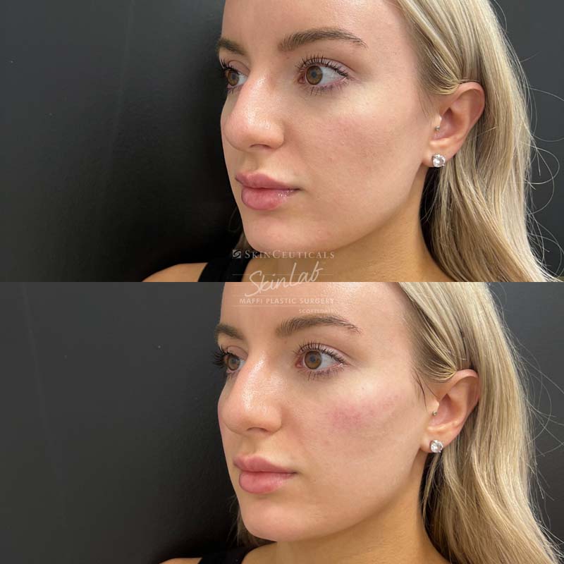 Cheek Filler Marge Image