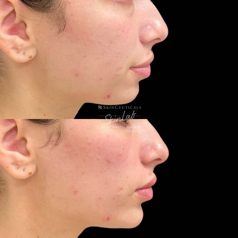 Cheek & Chin Filler Marge Image