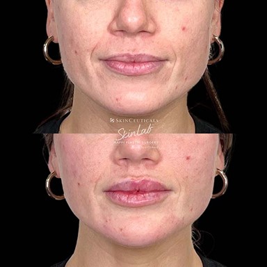 Juvederm Ultra & Juvederm Voluma Marge Image
