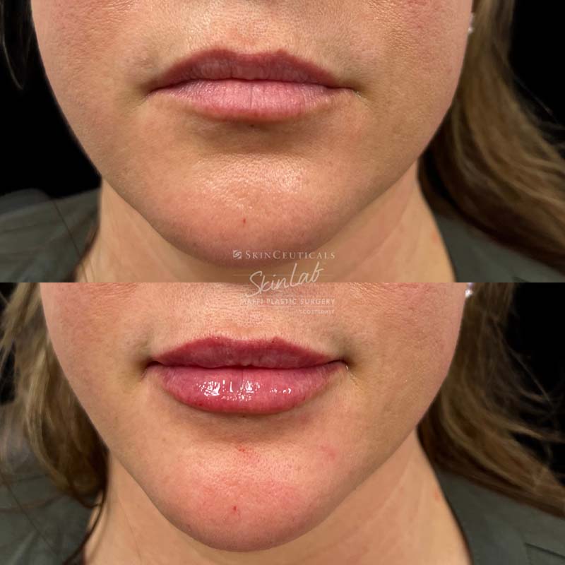 Lip Filler Marge Image