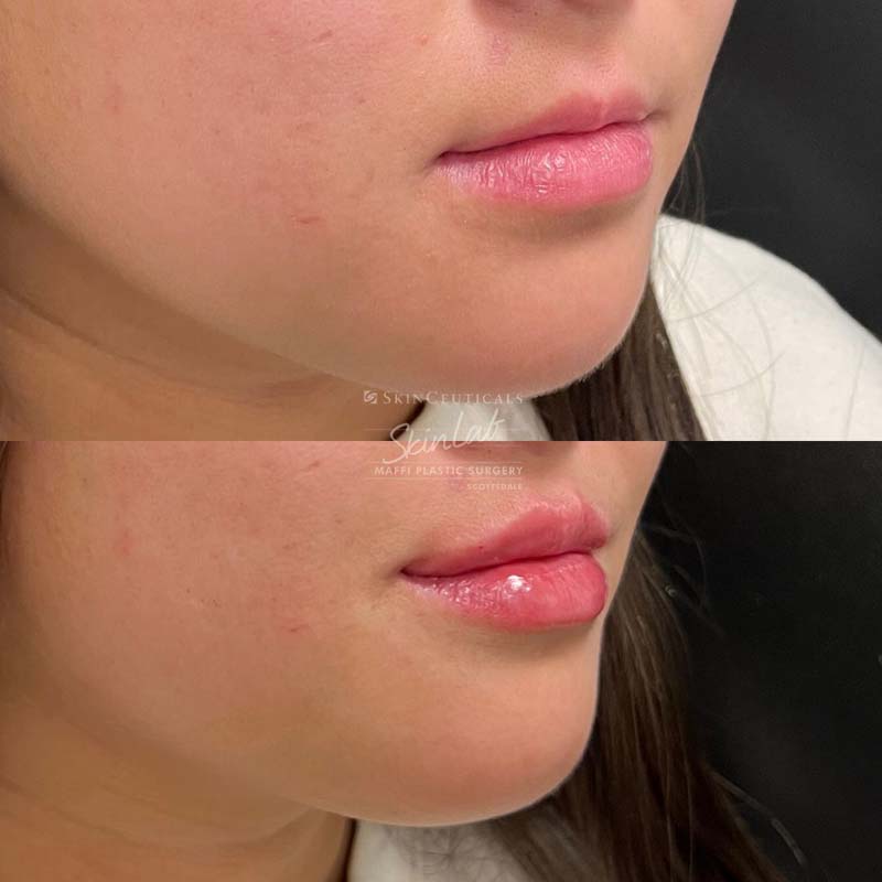 Lip Filler Marge Image