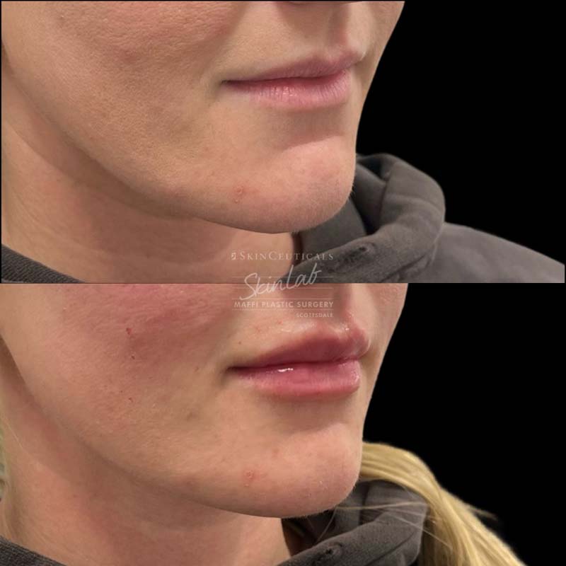 Lip Filler Marge Image