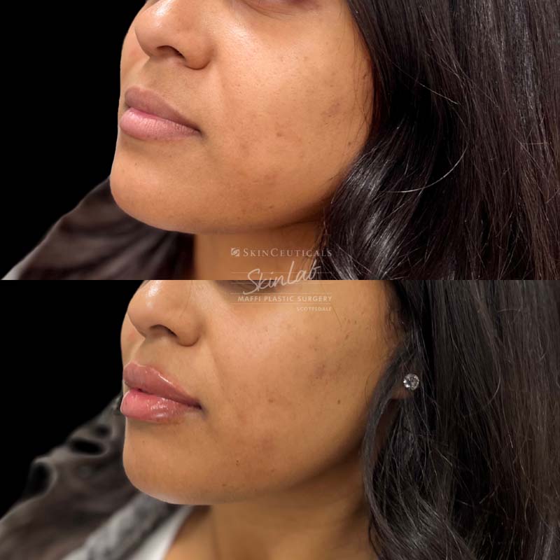 Lip Filler Marge Image