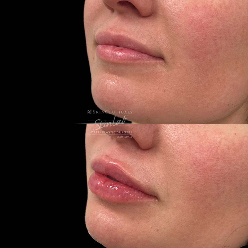 Lip Filler Marge Image