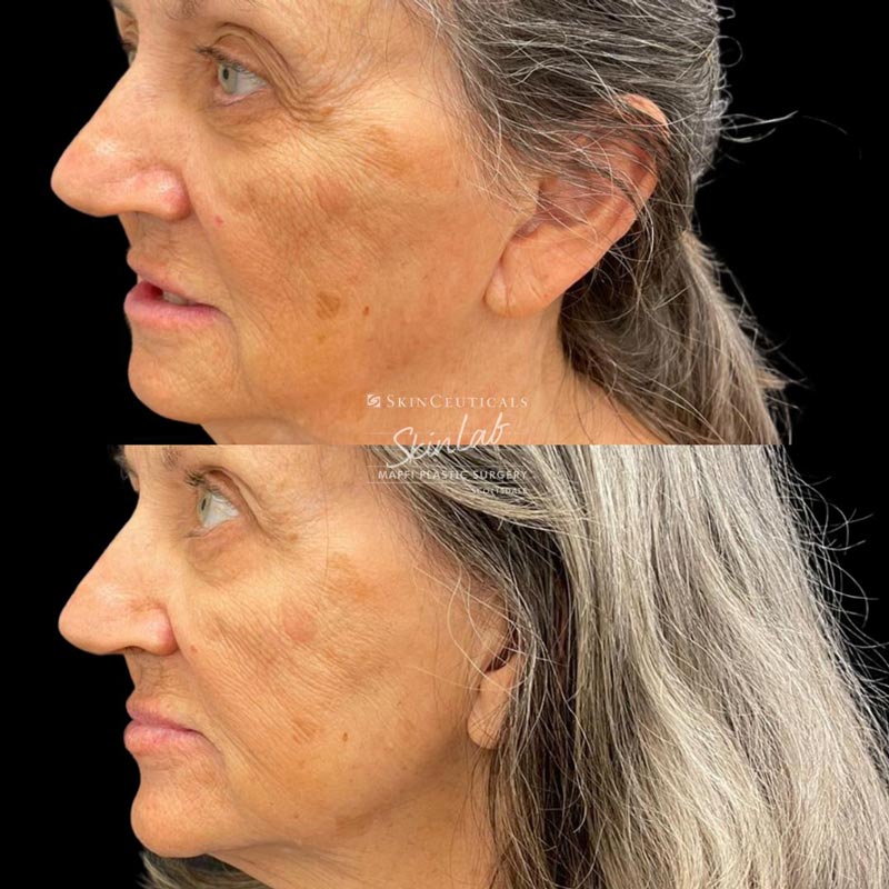 Radiofrequency Microneedling Marge Image