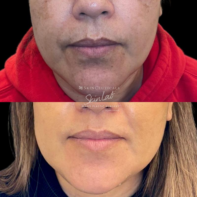 Chemical Peel Marge Image