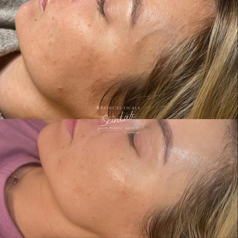 Chemical Peel Marge Image