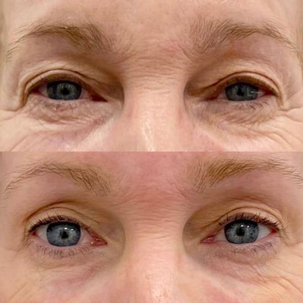 Radiofrequency Microneedling Marge Image