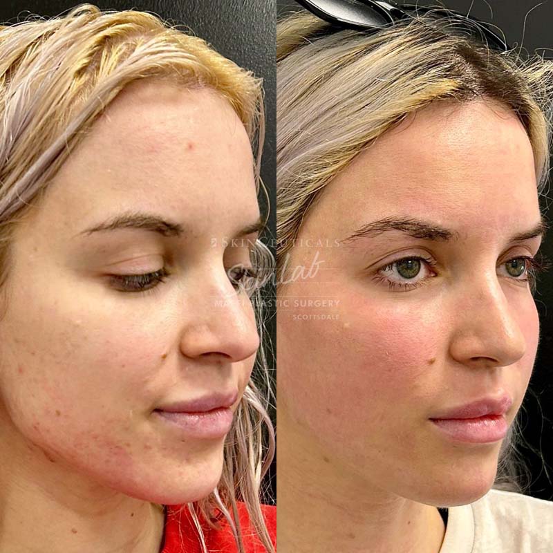 Radiofrequency Microneedling Marge Image